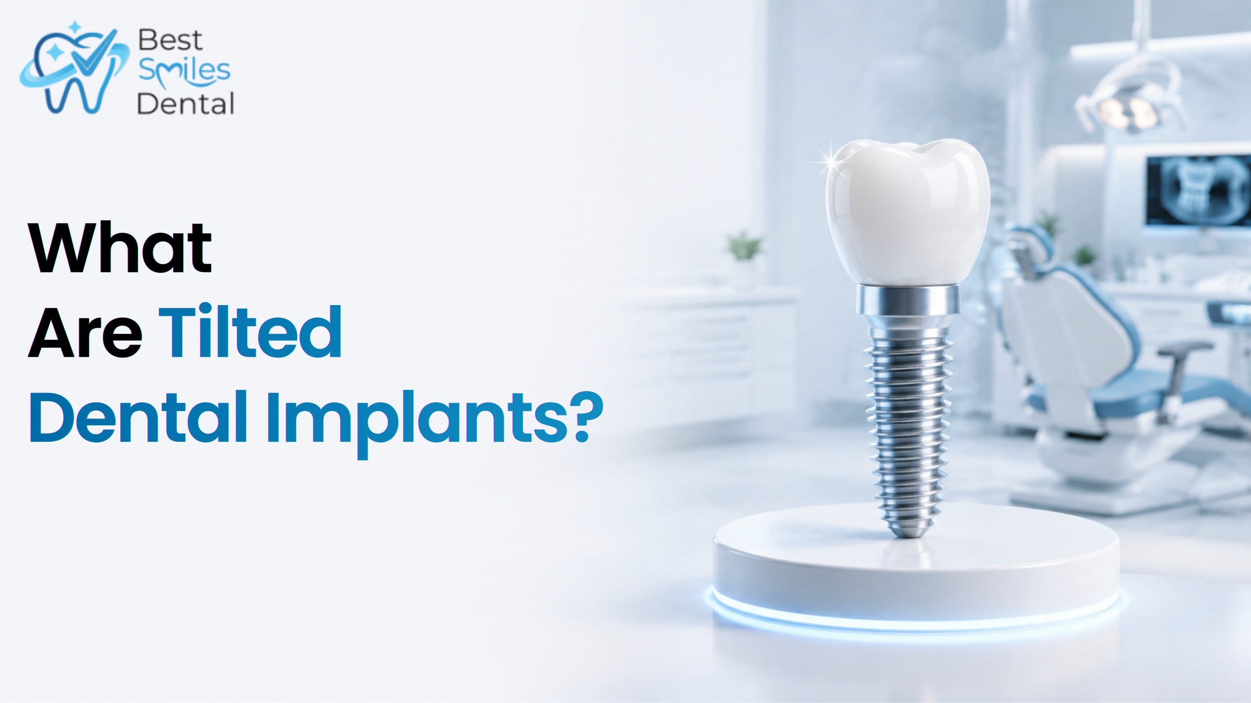 What Are Tilted Implants and Why Are They Used Intentionally?
